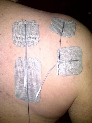 Supraspinatus + infraspinatus EMS.jpg